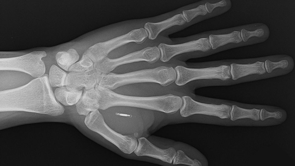 Röntgenový snímok zobrazujúci implantát Walletmor, ktorý sa implantuje do ruky človeka po lokálnom anestetiku